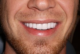 Flawlessly repaired smile with bright white teeth