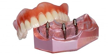 A model of an implant denture in Tallahassee.