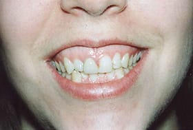 Smile with excessive gum tissue