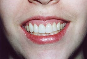Lovely white smile after gum recontouring