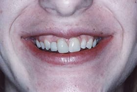 Smile with uneven teeth and gum line