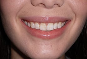 Woman's smile with very yellowed teeth