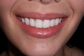 Brilliantly white gorgeous patient's smile