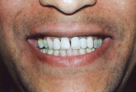 Man with lines around front dental crowns
