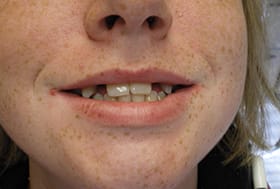 Smile with large gaps around front two teeth