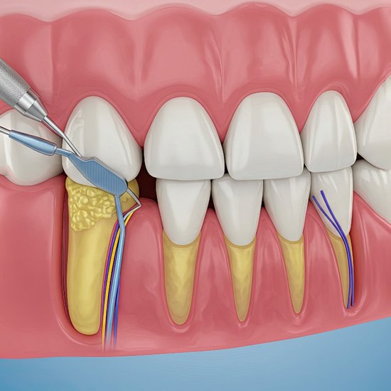 A CGI image of a scaling and root planing treatment