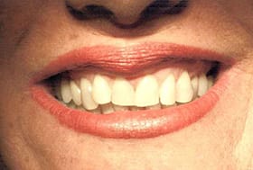 Woman's smile with crooked misshapen teeth