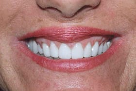 Woman's flawless bright white smile