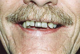 Older man's smile with uneven discolored teeth