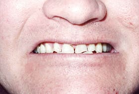 Teeth severely worn and discolored