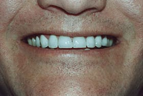 Man's smile with white aligned teeth