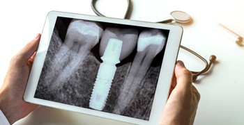 Dental implant X-ray after bone grafting in Tallahassee