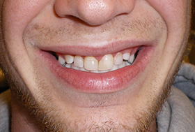 Smile with discolored teeth of uneven lengths