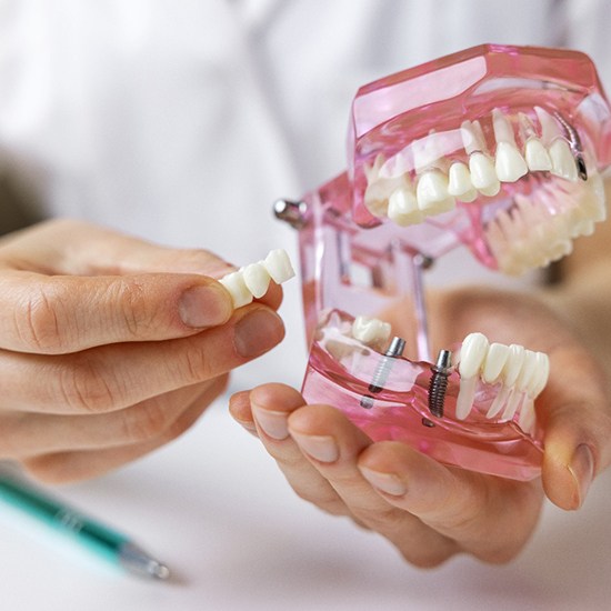 Dentist holding model showing implant dental bridge options 