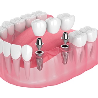 An illustration of an implant bridge 