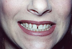 Smile with large gaps between teeth
