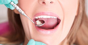 Woman's smile examined with dental mirror