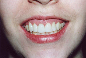 Lovely white smile after gum recontouring