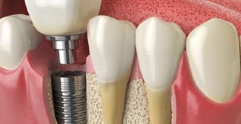 dental implant teeth