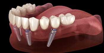 implants holding dentures