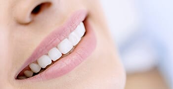 Close up of smile with porcelain veneers