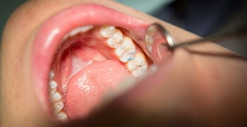 Teeth examined after placing fillings