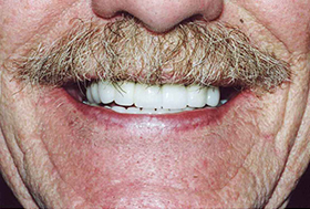 Older man's smile with perfect teeth