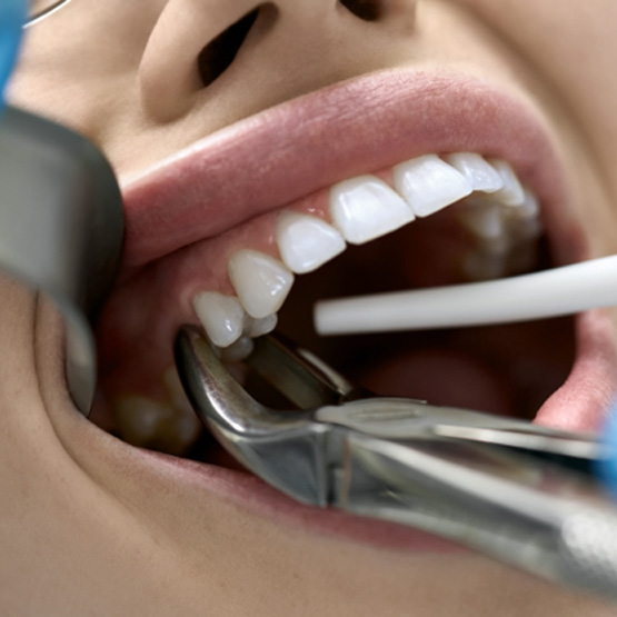 Closeup of forceps grasping a patient’s tooth for extraction