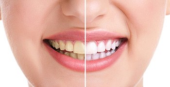 At-home teeth whitening in Tallahassee 