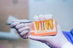 dentist pointing at a diagram of dental implants