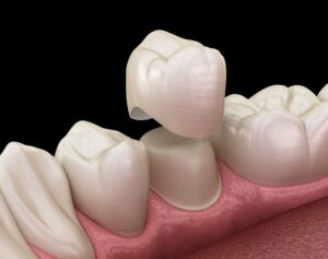 a digital illustration showing a dental crown being placed over a prepared tooth