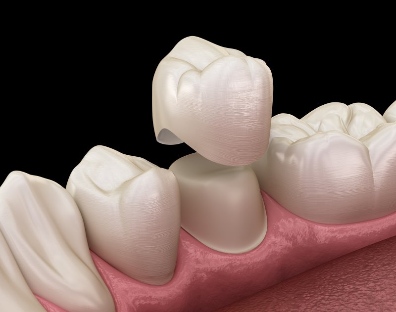 How are Teeth Prepared for Dental Crowns? | Boyd & Walther How are Teeth Prepared for Dental Crowns? | Boyd & Walther
